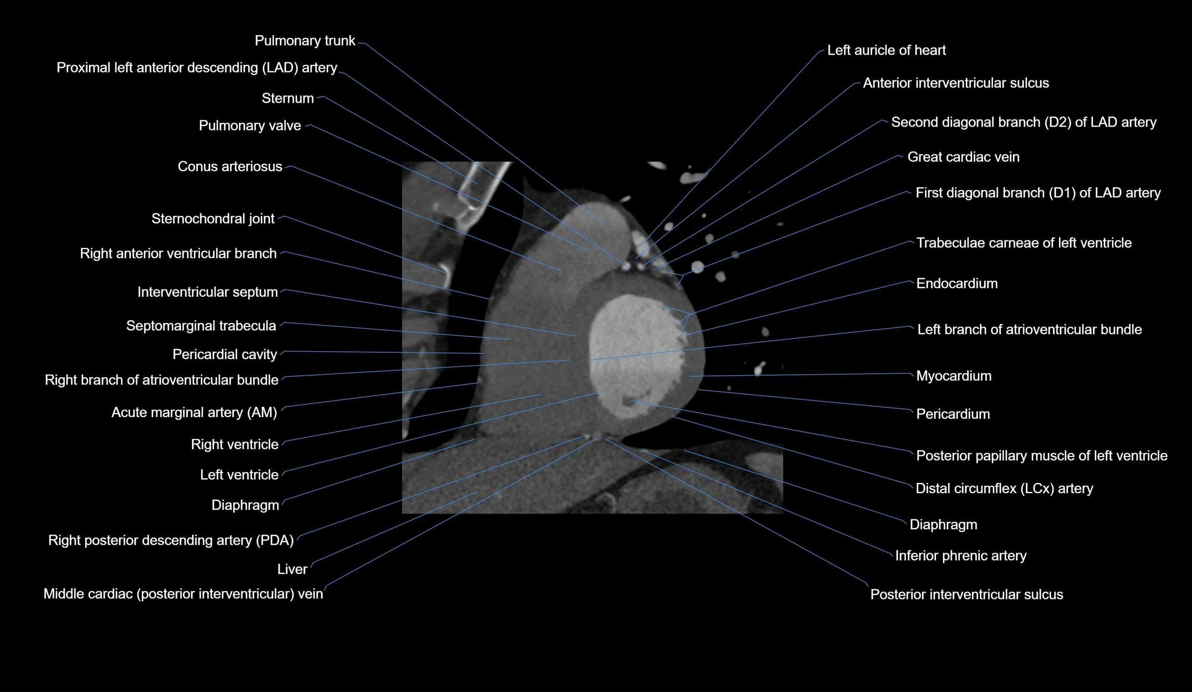 CT heart (coronary angiogram) short axis view  cross sectional anatomy labelled radiology image-00028.webp